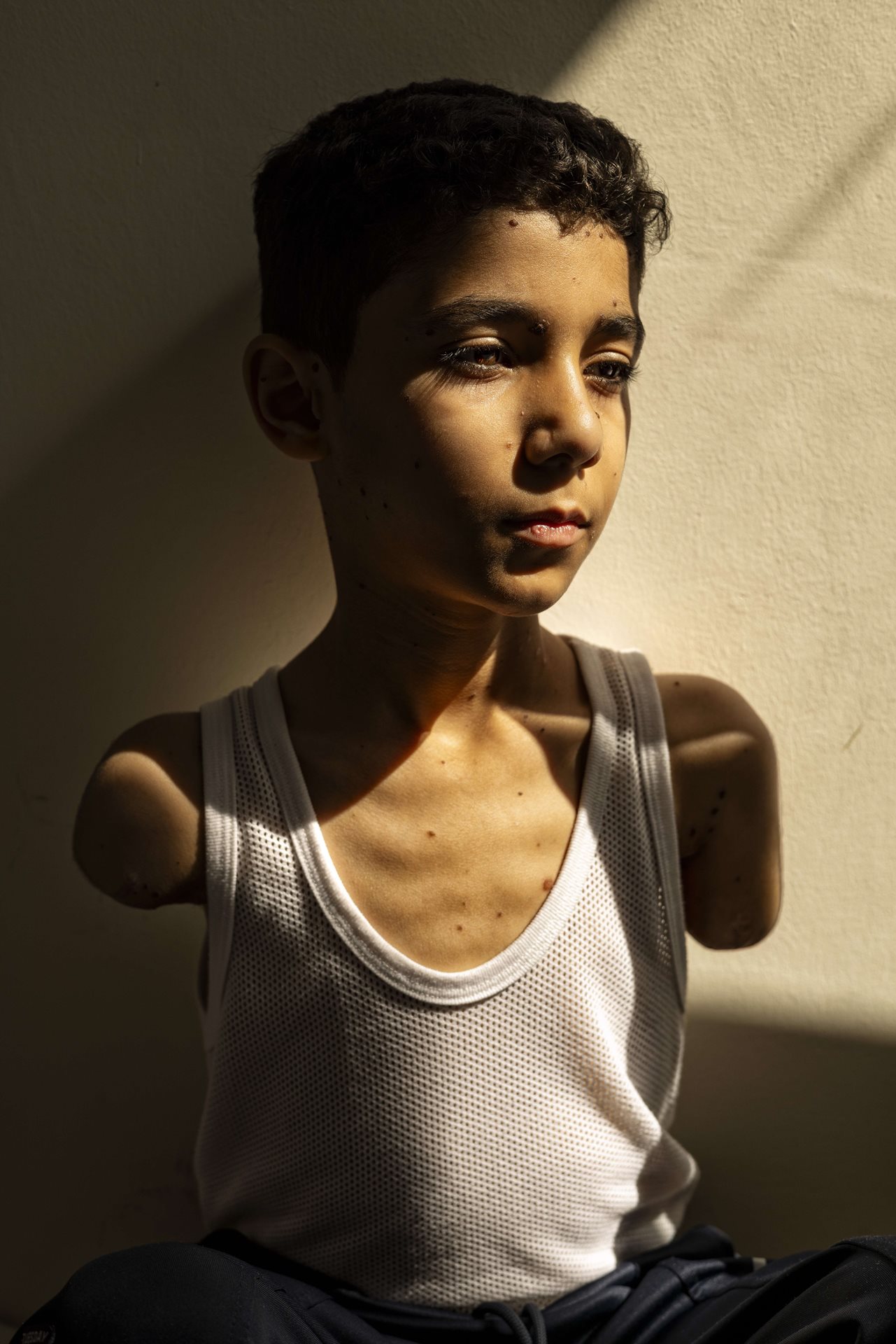 Mahmoud Ajjour (9), who was injured during an Israeli attack on Gaza City in March 2024, finds refuge and medical help in Doha, Qatar.&nbsp;